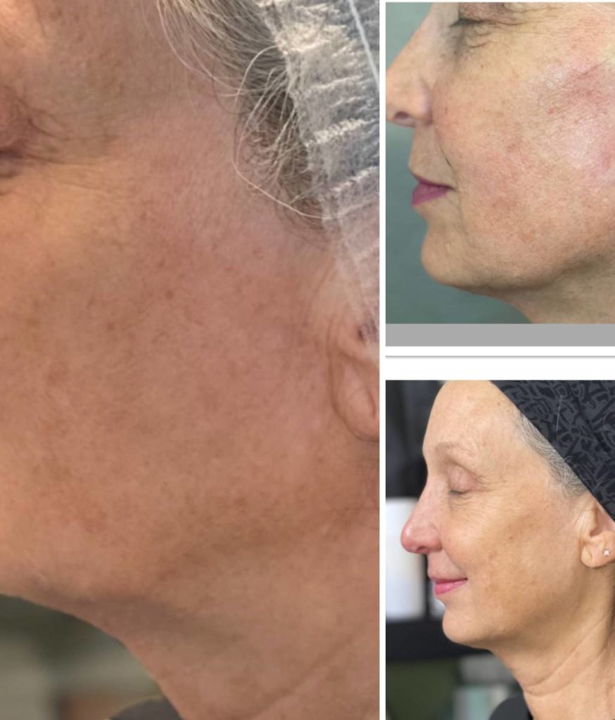 Before and After PDO Thread Lift | Northwest Beauty and Wellness at Sequim, WA