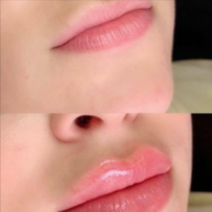 Before and After Lip Injectable treatment | Northwest Beauty and Wellness at Sequim, WA