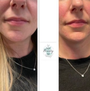 Before and After Lip Injection treatment | Northwest Beauty and Wellness at Sequim, WA