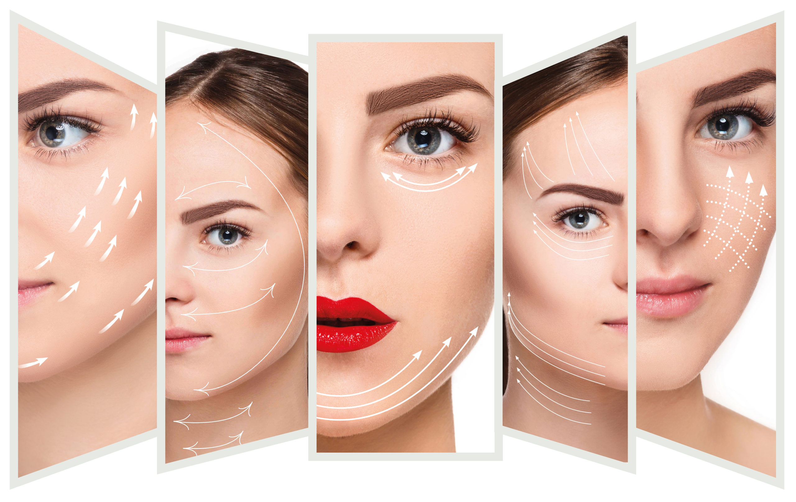 Treatment structure lines on Women's face | HA Dermal Fillers in Northwest Beauty and Wellness at Sequim, WA