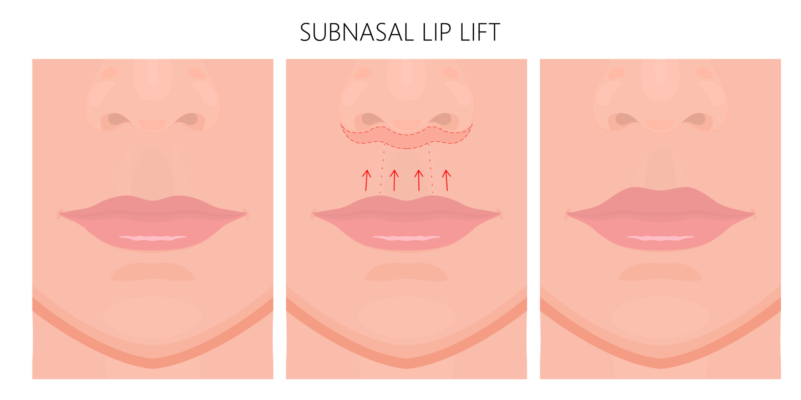 Lip lift treatment structure | Northwest Beauty and Wellness at Sequim, WA