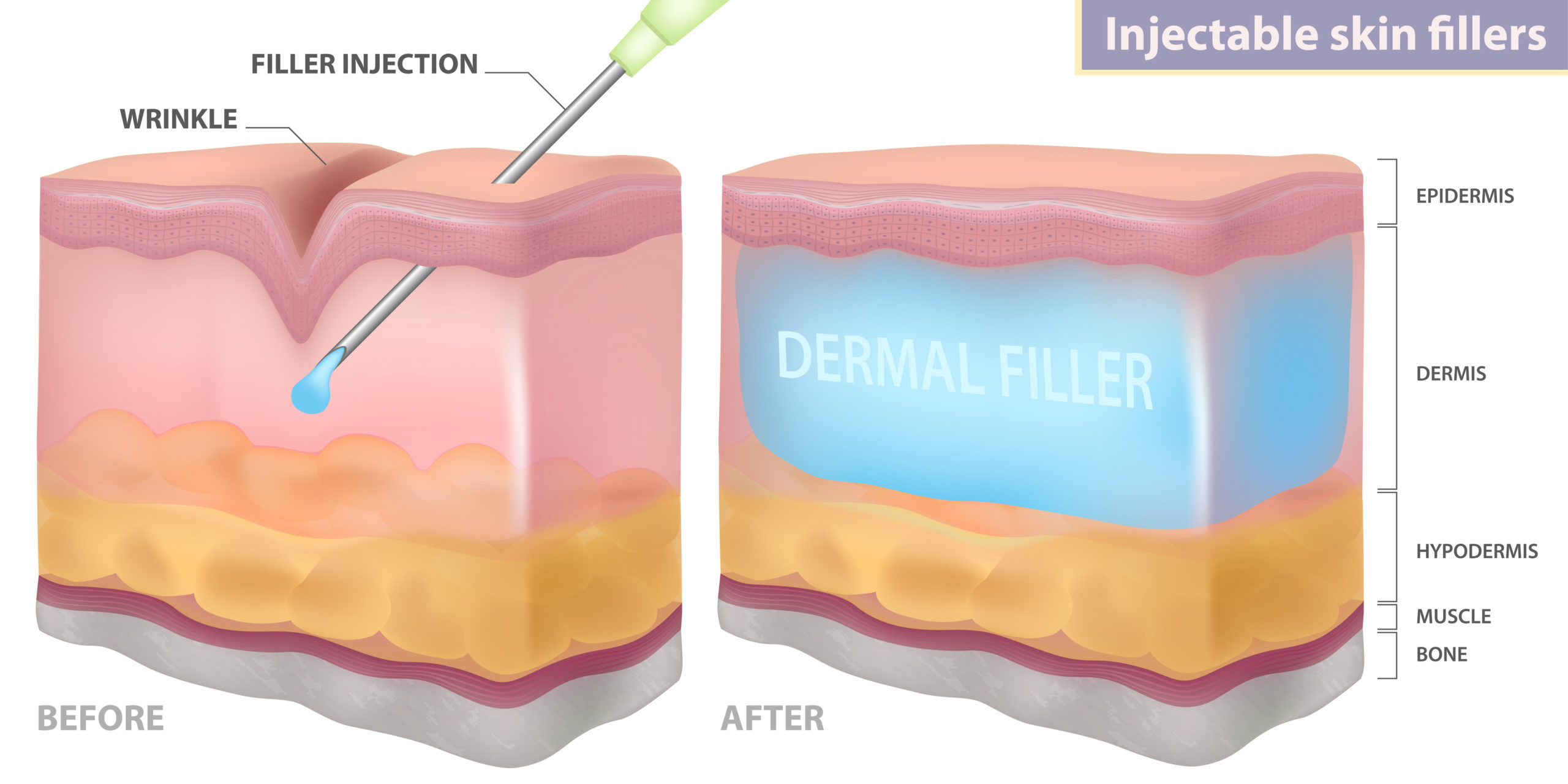 Injectable skin fillers treatment structure | Northwest Beauty and Wellness at Sequim, WA