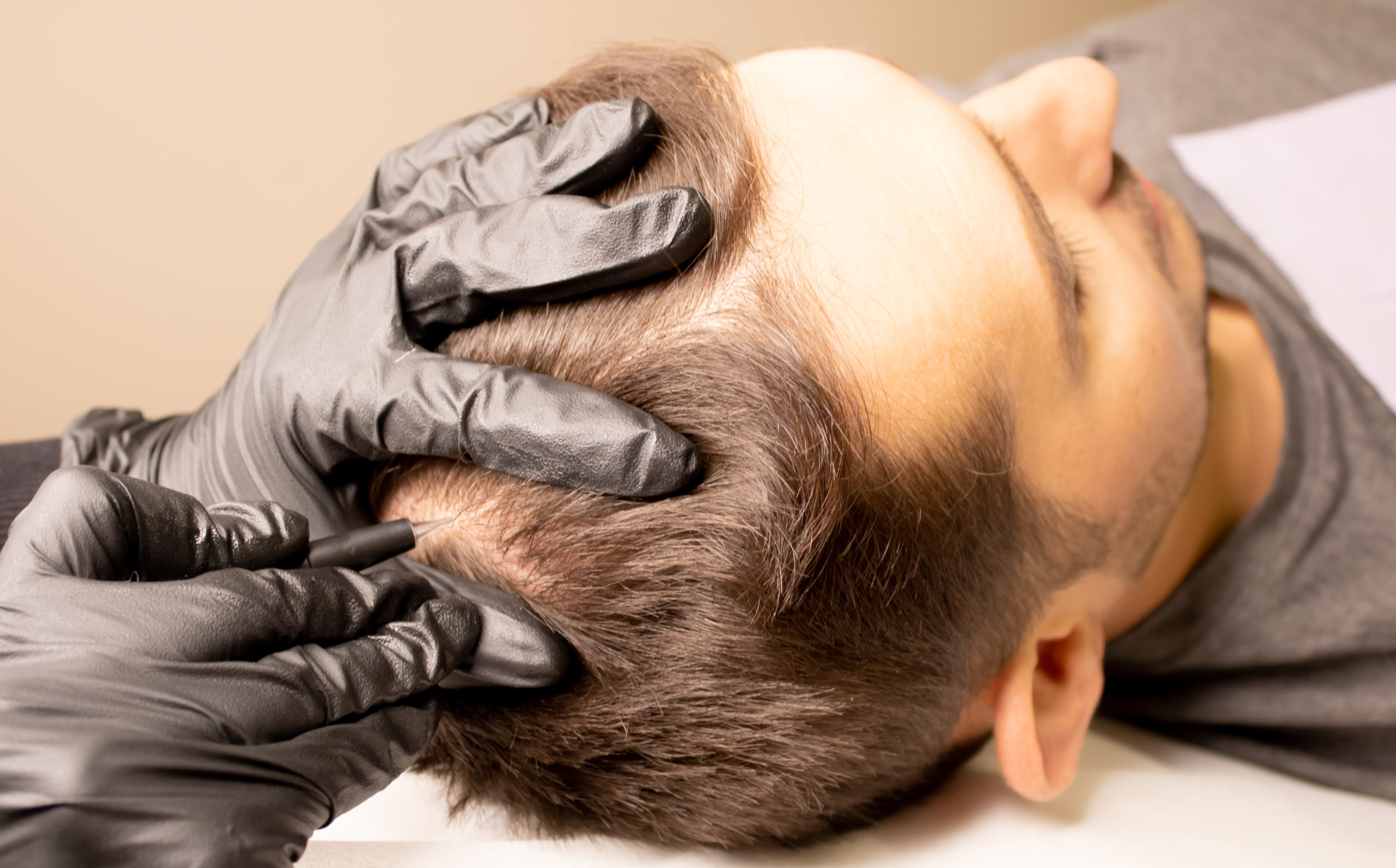 A Man getting Hair restoration | Northwest Beauty and Wellness at Sequim, WA