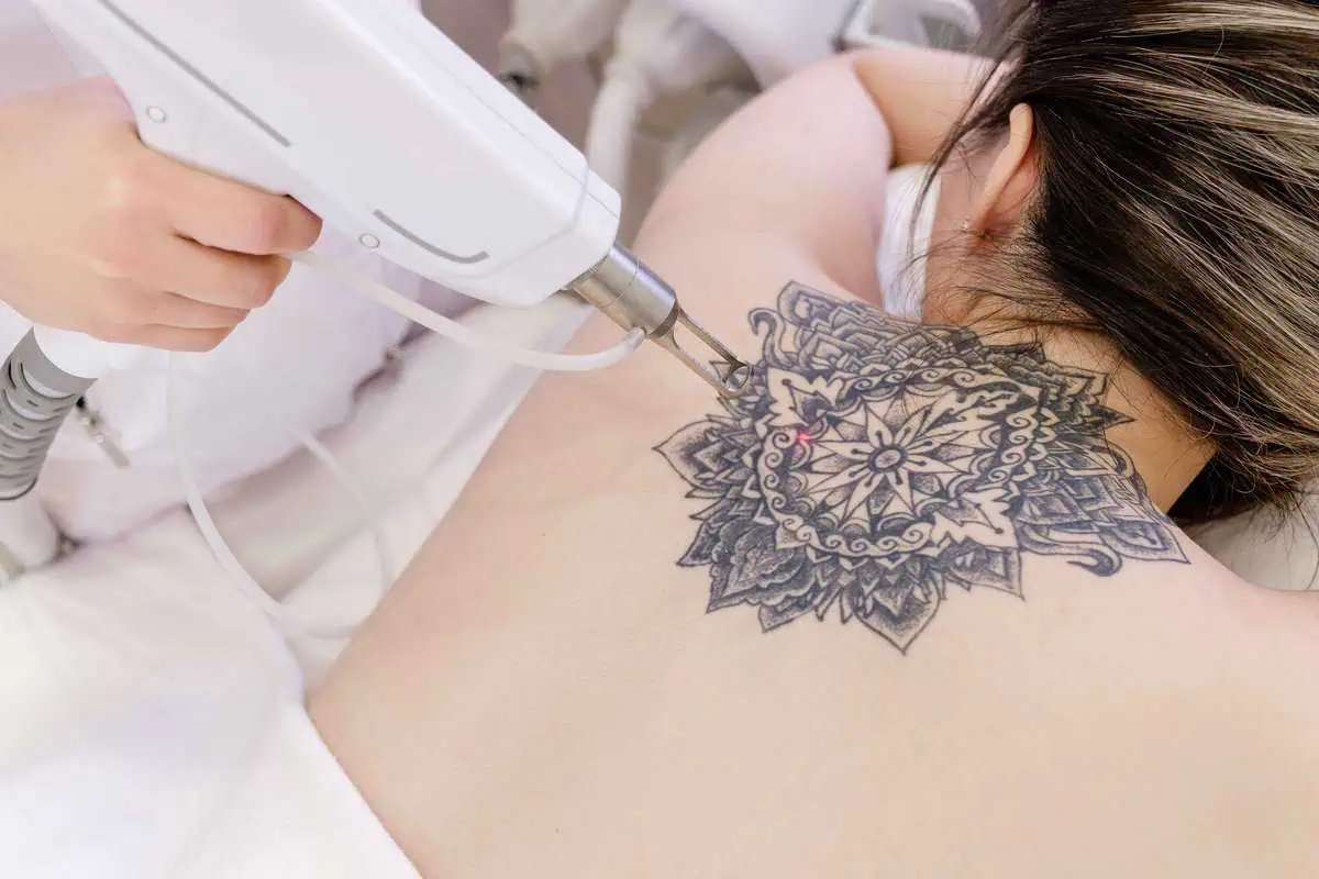 Laser Tattoo Removal in Sequim, WA by NW Beauty