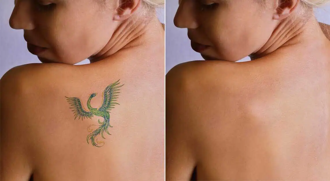 Tattoo Removal in Sequim by Northwest Beauty and Wellness