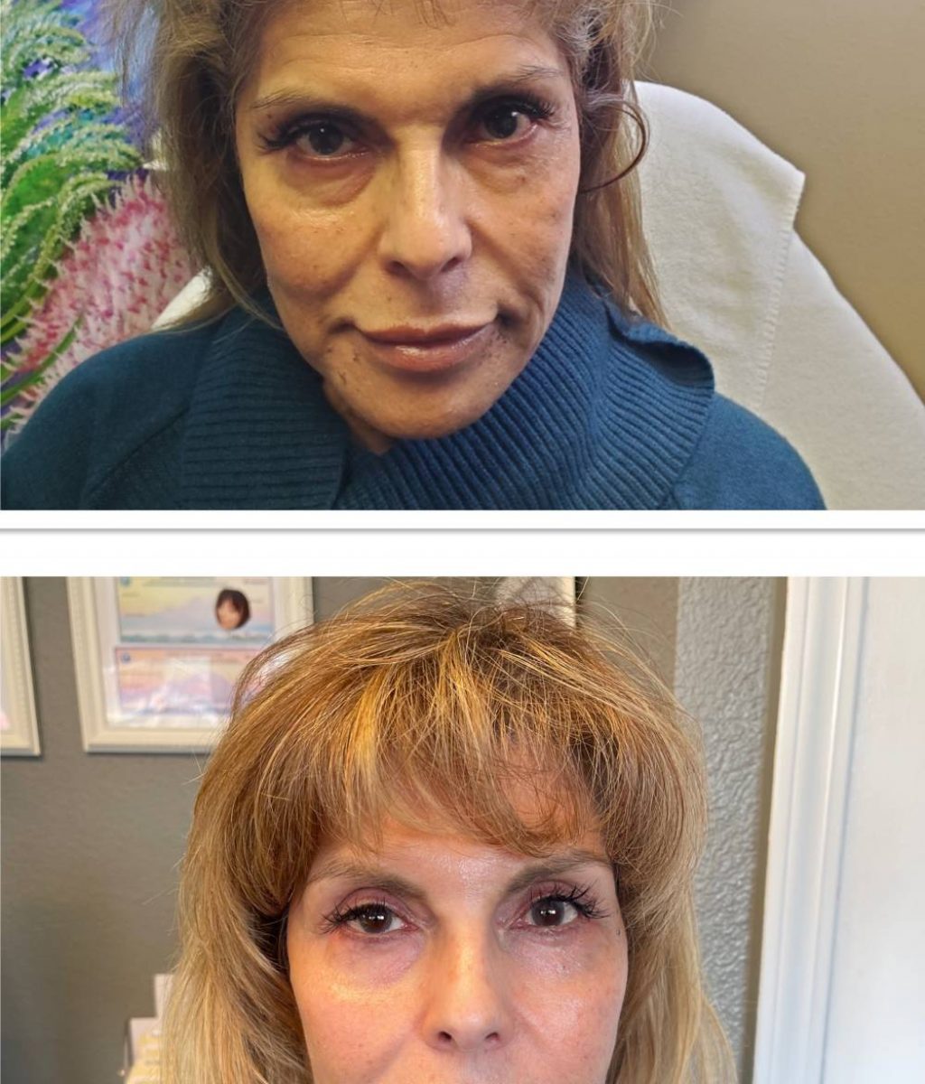 Before and After PDO Thread Lift | Northwest Beauty and Wellness at Sequim, WA