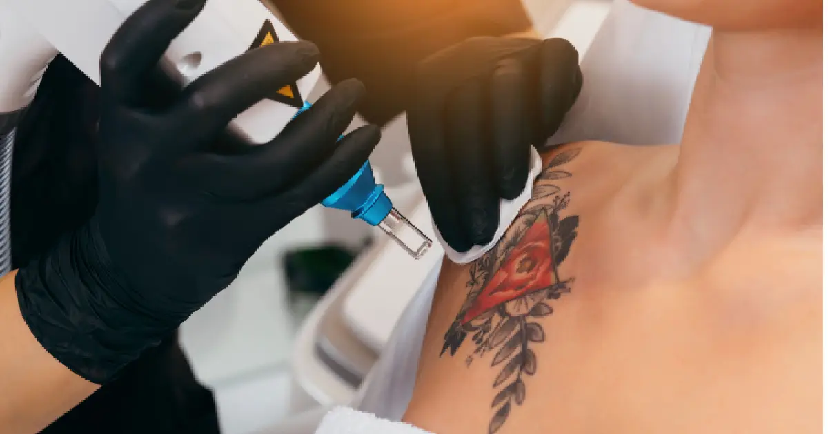 Laser Tattoo Removal by Northwest Beauty and Wellness in Washington State