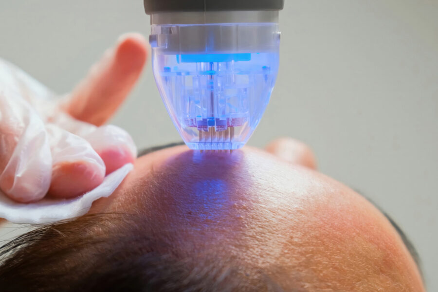 PiXel8 RF Microneedling in Sequim, WA | Northwest Beauty & Wellness
